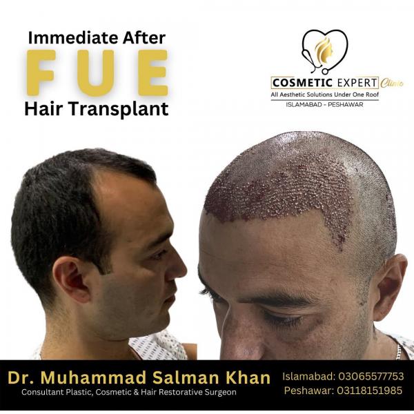 Hair Transplant Expert Archives - Hair Transplant | Looksstudio | Blog